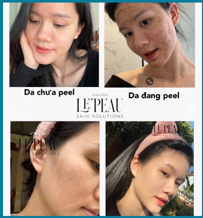 Peel da vi tảo Retinol Le'peau có tốt không?